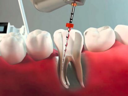 Endodontic dental treatment (ID:7664)