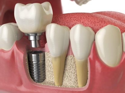 Dental implantation (ID:7667)