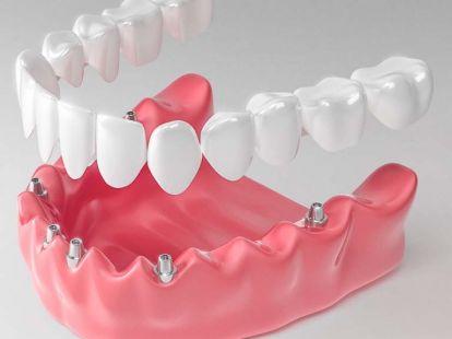 Prosthetics of teeth (ID:7669)