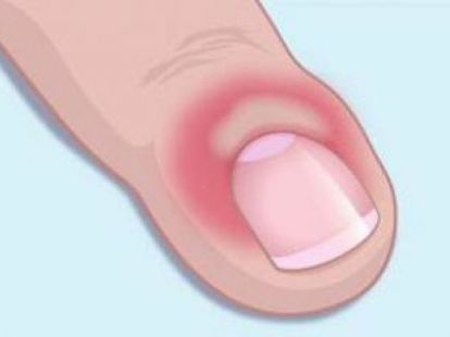 Panaritium treatment (ID:8401)