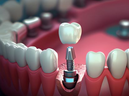 Turnkey dental implantation (ID:12098)