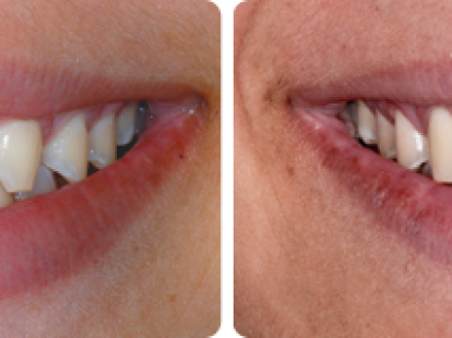 Basal dental implantation (ID:12099)