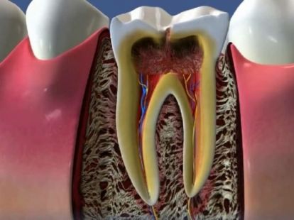 Pulpitis treatment: symptoms, stages, prices (ID:12100)