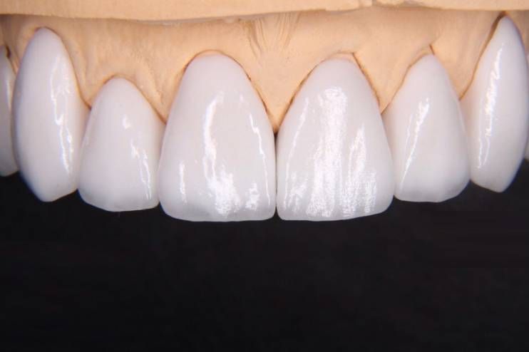 Керамические виниры в Дубае - Ref: 1079 фото 3