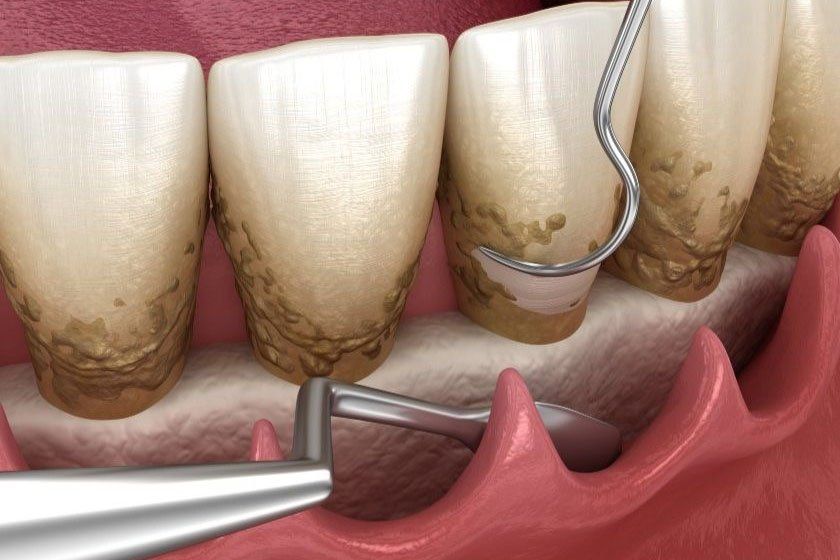 Лечение пародонтита в Барселоне - Ref: 5725 фото 1