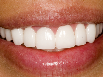 Porcelain Dental Veneers (ID:1079)