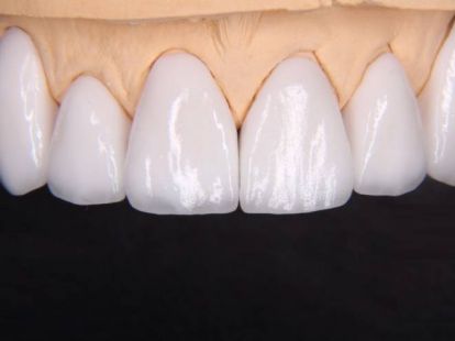 Керамические виниры в Дубае - Ref: 1079 фото 3