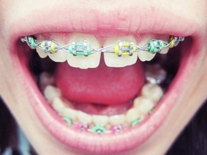 Детская ортодонтия в Дубае - Ref: 1081 фото 3