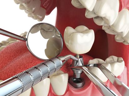 Dental implants (ID:1083)