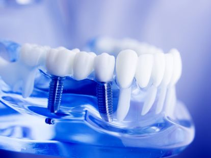 Имплантация зубов в Дубае - Ref: 1083 фото 2