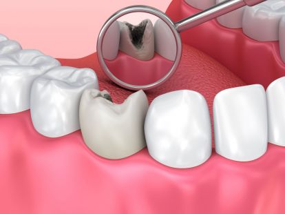 Dental caries treatment in Barcelona (ID:5668)