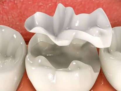 Get a filling on your tooth in Barcelona (ID:5669)