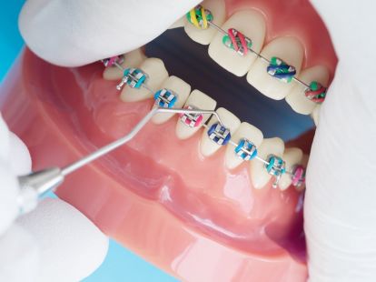 Braces (ID:5686)