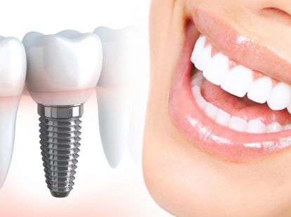 Dental implants in Barcelona (ID:5724)