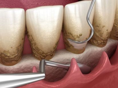 Treatment of periodontitis in Barcelona (ID:5725)